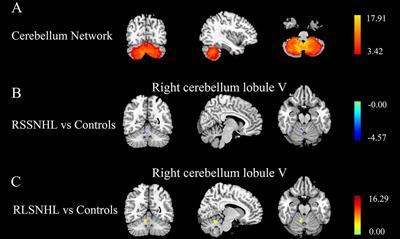 Abnormal cerebellar network and effective connectivity in sudden and long-term sensorineural hearing loss